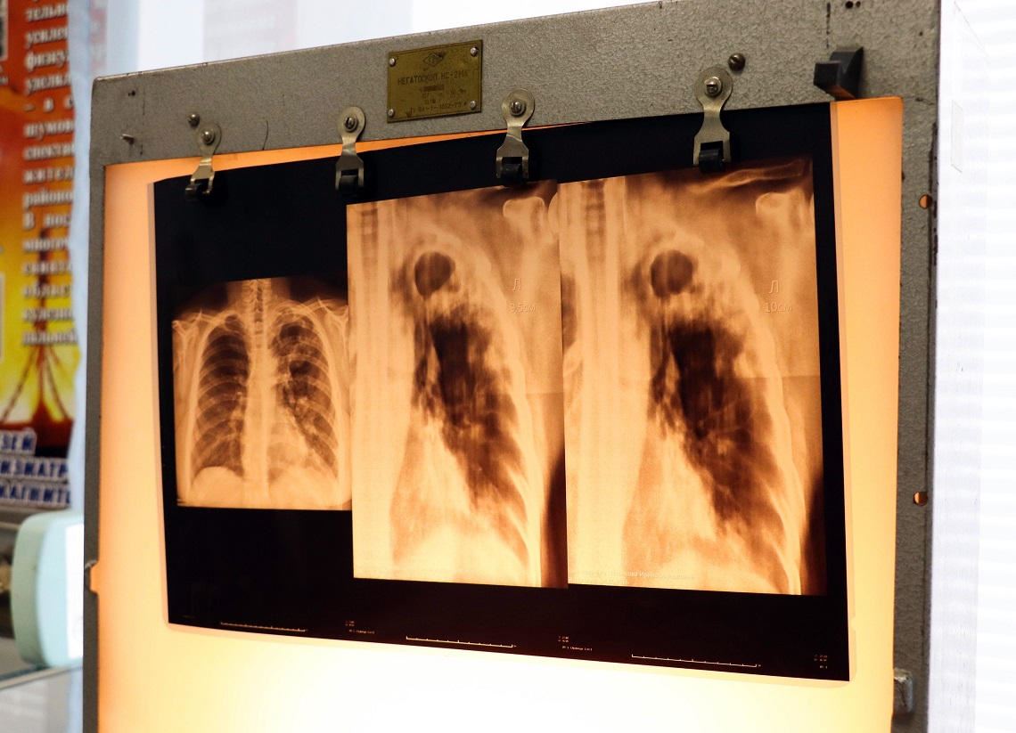 Фото снимок лёгких при помощи флюорографии